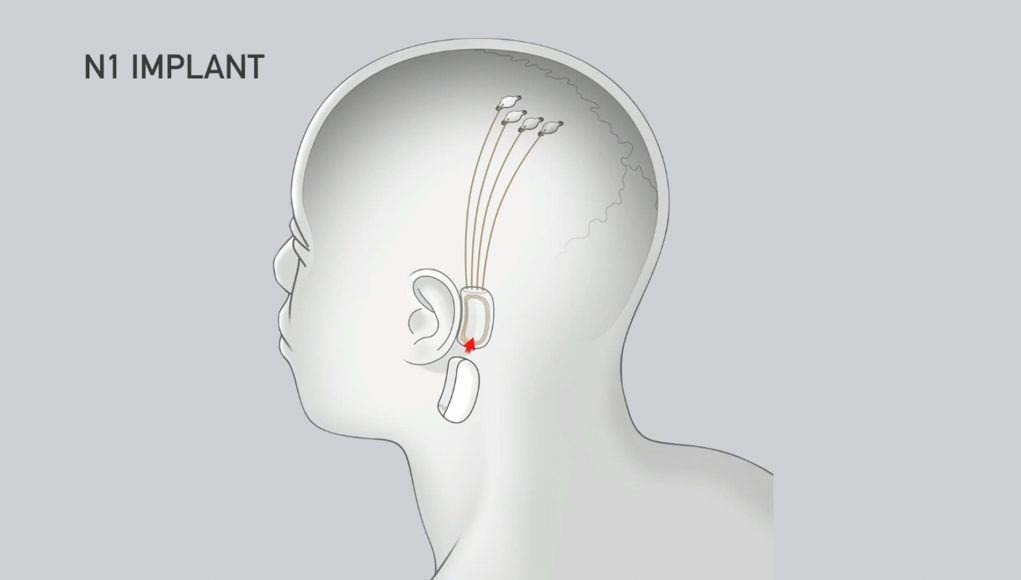 Neuralink脑机接口有望在明年展开人体植入测试